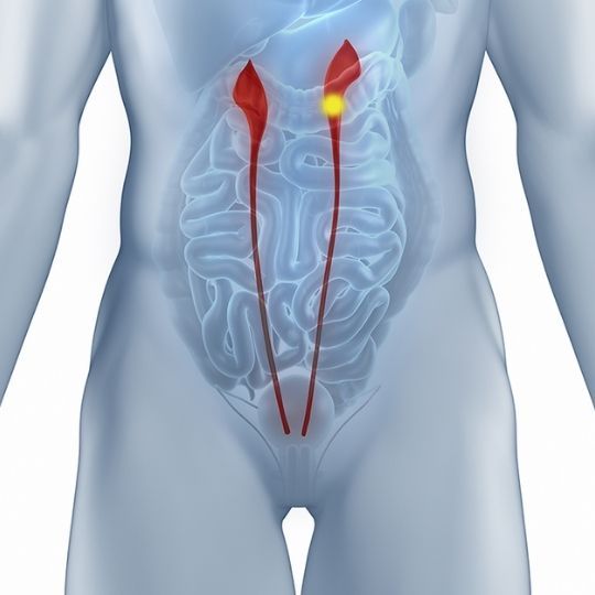  Estenose Junção Ureteropiélica (JUP)