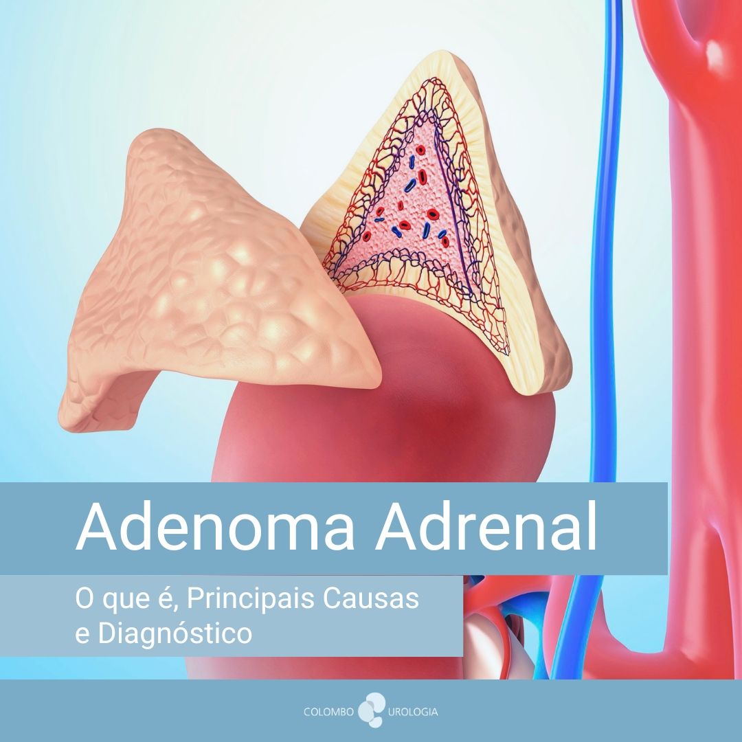 Adenoma-Adrenal